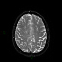 File:Cerebral amyloid angiopathy (Radiopaedia 77506-89664 Axial DWI 49).jpg