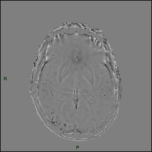 Cerebral amyloid angiopathy (Radiopaedia 77506-89664 H 52).jpg