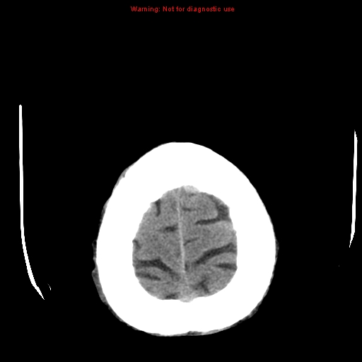 File:Cerebral and orbital tuberculomas (Radiopaedia 13308-13310 Axial non-contrast 26).jpg