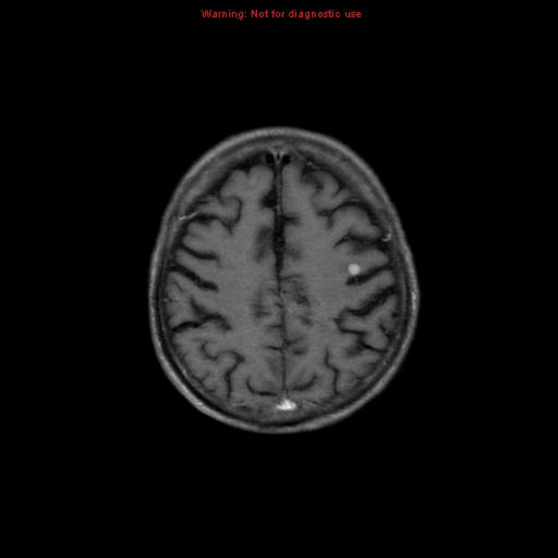 File:Cerebral and orbital tuberculomas (Radiopaedia 13308-13311 Axial T1 C+ 16).jpg