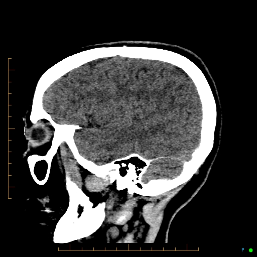 File:Cerebral arteriovenous malformation (AVM) (Radiopaedia 78162-90706 A 60).jpg
