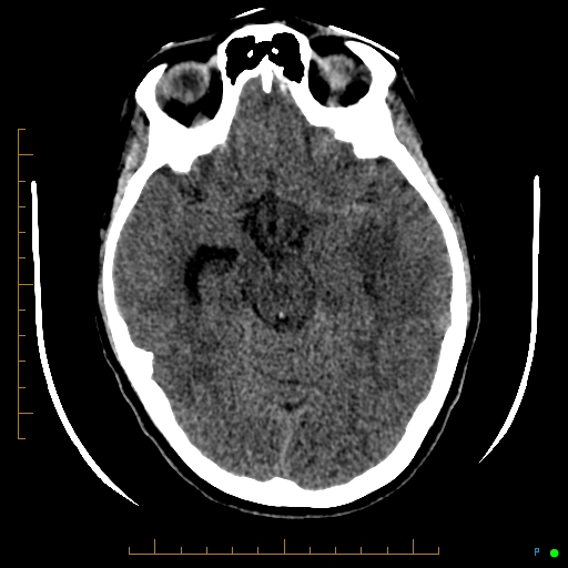File:Cerebral arteriovenous malformation (AVM) (Radiopaedia 78162-90706 Axial non-contrast 26).jpg