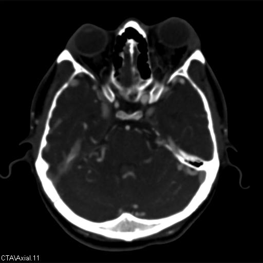 Cerebral arteriovenous malformation (Radiopaedia 28518-28759 B 11).jpg