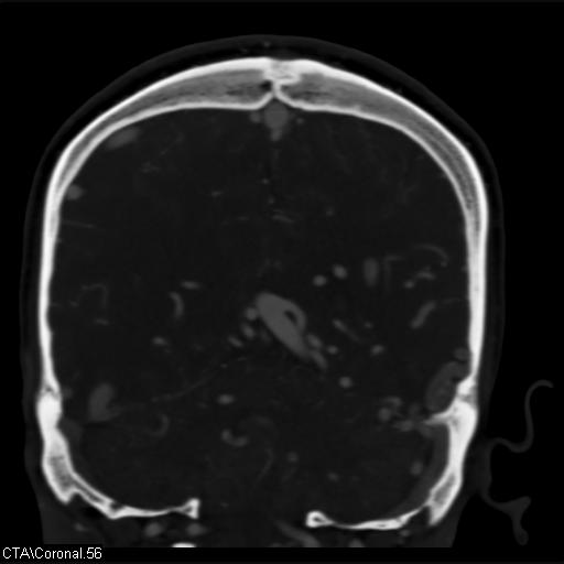 Cerebral arteriovenous malformation (Radiopaedia 28518-28759 C 56).jpg