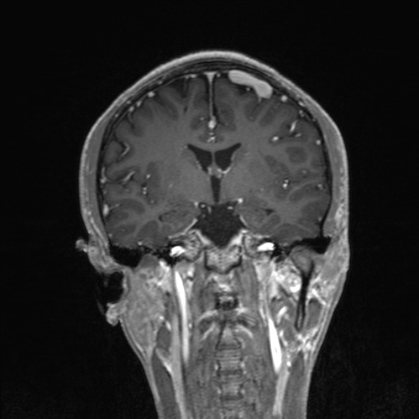 Cerebral arteriovenous malformation (Radiopaedia 30198-30813 F 30).jpg