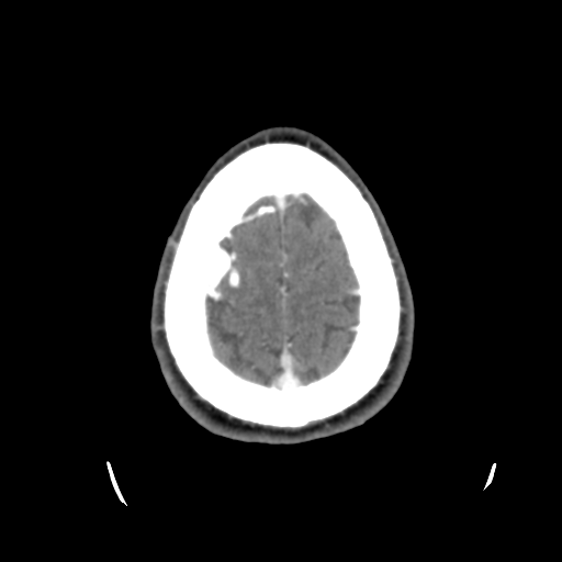 Cerebral arteriovenous malformation (Radiopaedia 55798-62371 B 46).png