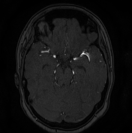 Cerebral arteriovenous malformation (Radiopaedia 74411-85654 Axial MRA 46).jpg