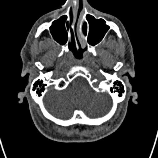 File:Cerebral arteriovenous malformation (Radiopaedia 78188-90746 Axial non-contrast 24).jpg