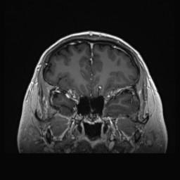 Cerebral arteriovenous malformation (Radiopaedia 84015-99245 Coronal T1 C+ 47).jpg