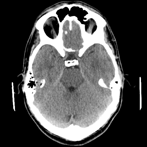 Cerebral arteriovenous malformation (Spetzler-Martin grade 2) (Radiopaedia 41262-44076 Axial non-contrast 20).png