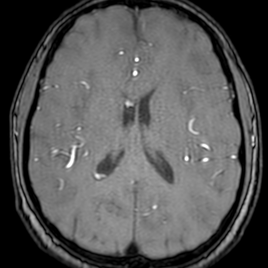 Cerebral arteriovenous malformation at posterior body of corpus callosum (Radiopaedia 74111-84925 Axial MRA 131).jpg