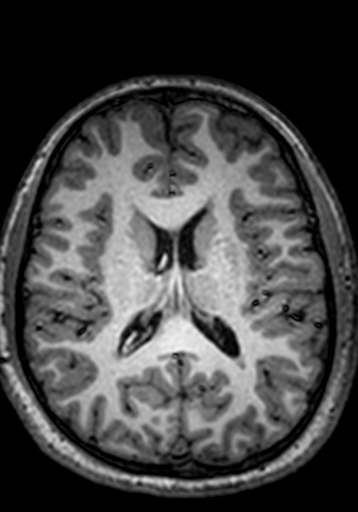 Cerebral arteriovenous malformation at posterior body of corpus callosum (Radiopaedia 74111-84925 Axial T1 120).jpg
