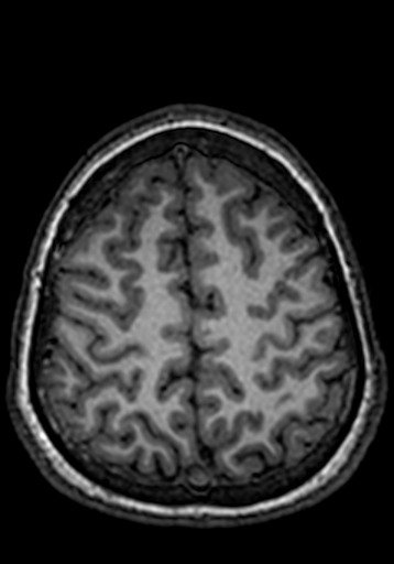 Cerebral arteriovenous malformation at posterior body of corpus callosum (Radiopaedia 74111-84925 Axial T1 53).jpg