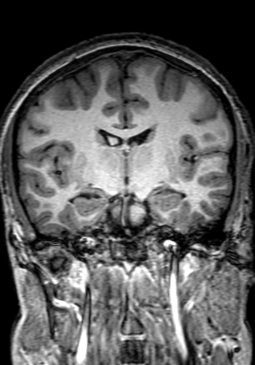 Cerebral arteriovenous malformation at posterior body of corpus callosum (Radiopaedia 74111-84925 Coronal T1 161).jpg