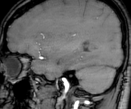 Cerebral arteriovenous malformation at posterior body of corpus callosum (Radiopaedia 74111-84925 J 100).jpg