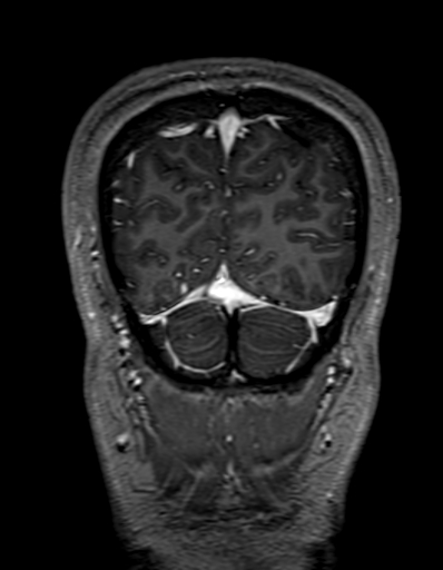 Cerebral arteriovenous malformation at posterior body of corpus callosum (Radiopaedia 74111-84925 K 333).jpg