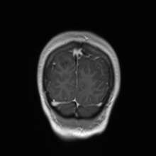 File:Cerebral cavernous venous malformation (Radiopaedia 70008-80021 Coronal T1 C+ 8).jpg