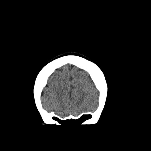 Cerebral cavernous venous malformation (Radiopaedia 70008-80022 non-contrast 9).jpg