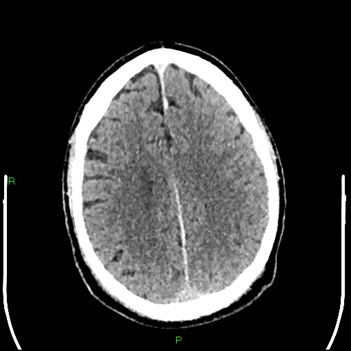 Cerebral contusions (Radiopaedia 33868-35039 Axial non-contrast 150).jpg
