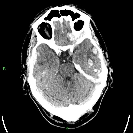Cerebral contusions (Radiopaedia 33868-35039 Axial non-contrast 65).jpg