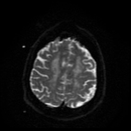 Cerebral embolic infarcts (embolic shower) (Radiopaedia 49837-55108 Axial DWI 11).jpg