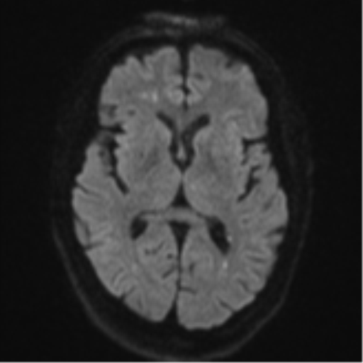 File:Cerebral embolic infarcts (embolic shower) (Radiopaedia 57395-64342 Axial DWI 55).png