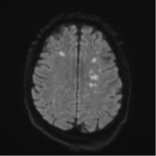 Cerebral embolic infarcts (embolic shower) (Radiopaedia 57395-64342 Axial DWI 61).png