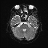 Cerebral embolic infarcts (embolic shower) (Radiopaedia 72391-82921 Axial DWI 8).jpg
