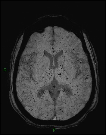 Cerebral fat embolism (Radiopaedia 35022-36525 Axial SWI 21).jpg