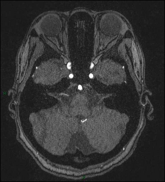 Cerebral fat embolism (Radiopaedia 35022-36525 Axial TOF 43).jpg