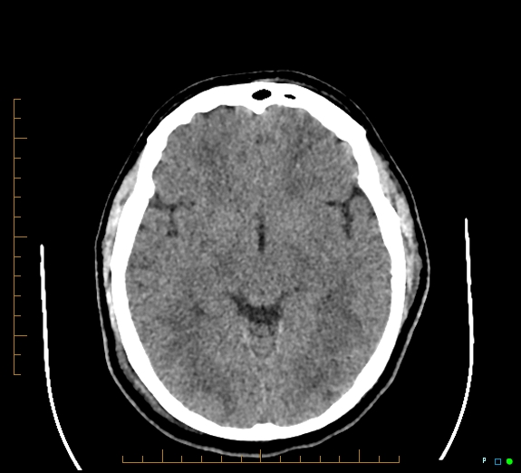 Cerebral fat embolism (Radiopaedia 85521-101220 Axial non-contrast 30).jpg