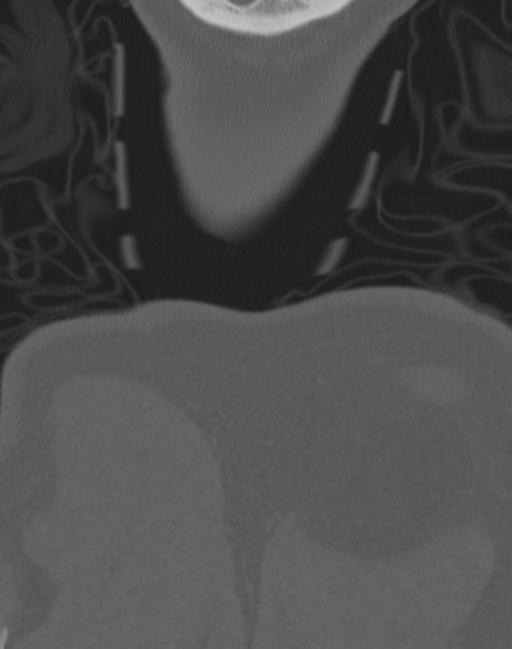 Cerebral hemorrhagic contusions and cervical spine fractures (Radiopaedia 32865-33841 Coronal bone window 91).jpg