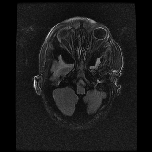 File:Cerebral manifestations of mucopolysaccharidosis type I (Radiopaedia 59171-66487 Axial FLAIR 3).jpg