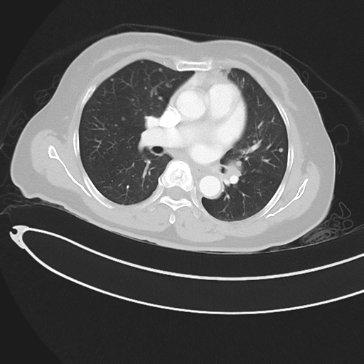 File:Cerebral metastases (Radiopaedia 33041-34055 Axial lung window 27).png