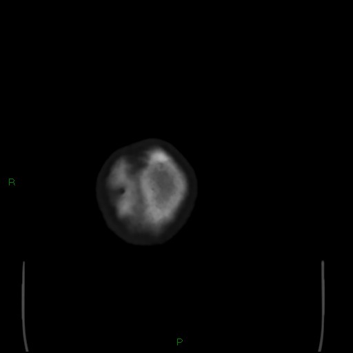Cerebral metastases - breast primary (Radiopaedia 77653-89857 Axial bone window 119).jpg