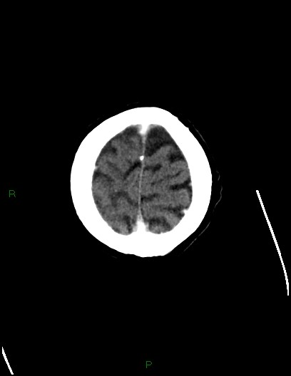 File:Cerebral metastases - ependymal and parenchymal (Radiopaedia 79877-93131 Axial C+ delayed 77).jpg