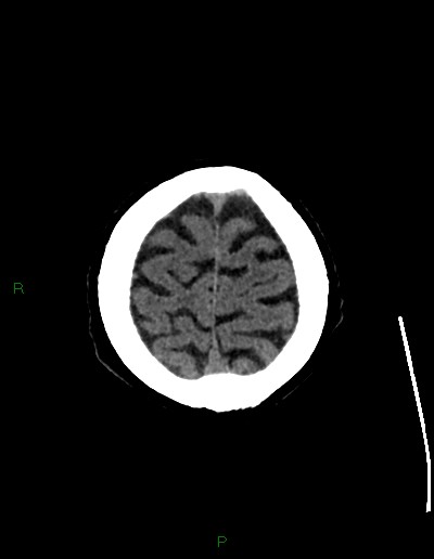 Cerebral metastases - ependymal and parenchymal (Radiopaedia 79877-93131 Axial non-contrast 72).jpg