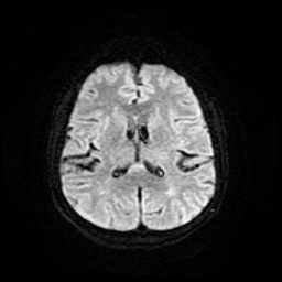 File:Cerebral metastases - melanoma (Radiopaedia 80972-94522 Axial DWI 18).jpg