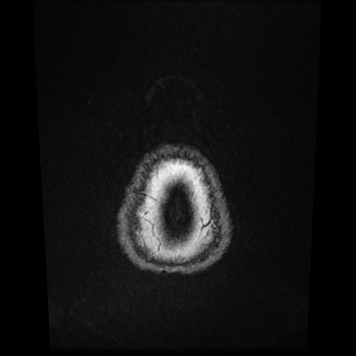 Cerebral metastases - melanoma (Radiopaedia 80972-94522 Axial T1 C+ 91).jpg