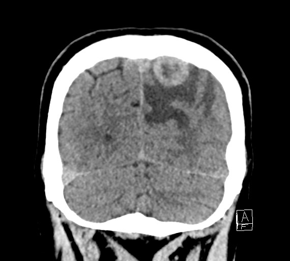 Cerebral metastases - testicular choriocarcinoma (Radiopaedia 84486-99855 Coronal C+ delayed 52).jpg