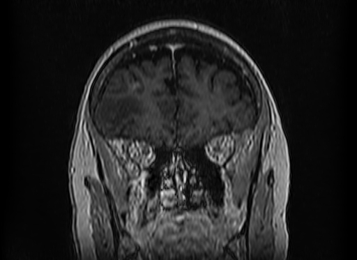 File:Cerebral metastases from lung cancer with amyloid angiopathy and cerebellopontine angle meningioma (Radiopaedia 74306-85191 Coronal T1 C+ 13).jpg