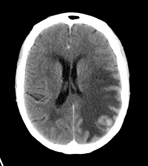 File:Cerebral metastasis (Radiopaedia 46744-51260 Axial C+ delayed 18).png
