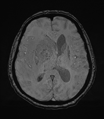 Cerebral metastasis to basal ganglia (Radiopaedia 81568-95413 Axial SWI 48).png