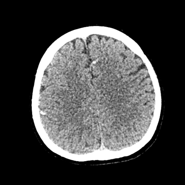 Cerebral ring enhancing lesions - cerebral metastases (Radiopaedia 44922-48818 Axial non-contrast 64).jpg