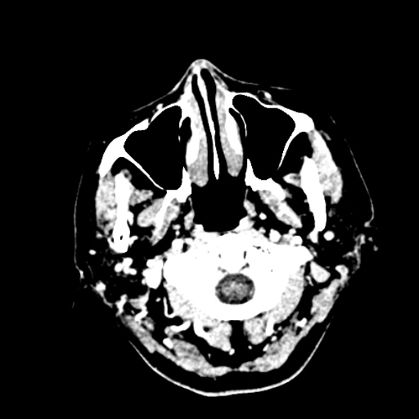 Cerebral ring enhancing lesions - cerebral metastases (Radiopaedia 44922-48818 B 4).jpg