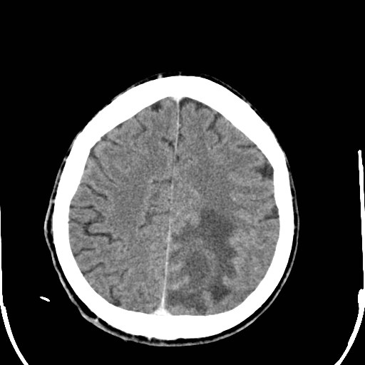 File:Cerebral toxoplasmosis (Radiopaedia 43956-47460 Axial C+ delayed 31).jpg