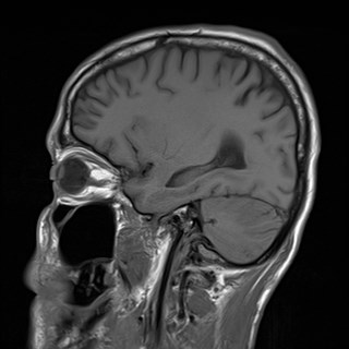 File:Cerebral toxoplasmosis (Radiopaedia 43956-47461 Sagittal T1 6).jpg