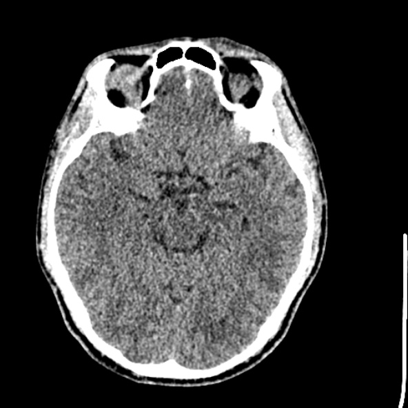 Cerebral toxoplasmosis (Radiopaedia 53993-60131 Axial non-contrast 33).jpg
