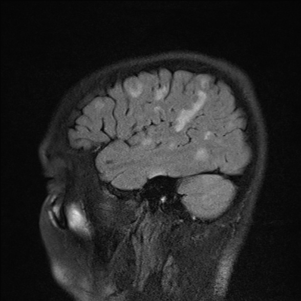File:Cerebral toxoplasmosis (Radiopaedia 53993-60132 Sagittal FLAIR 6).jpg