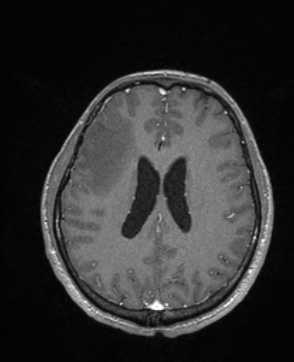 Cerebral toxoplasmosis (Radiopaedia 85779-101597 Axial T1 C+ 105).jpg